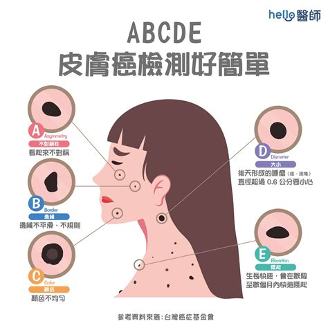 癦凸起|你要知： 臉上癦痣愈長愈大 黑色素定皮膚癌點識別？